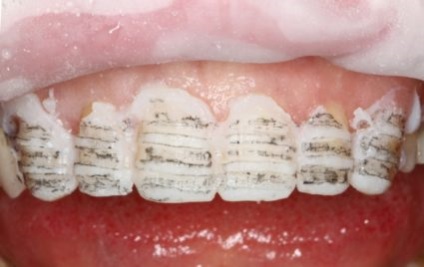 Țesutul osoasă al dintelui este o boală care afectează însăși dintele și rădăcina acestuia