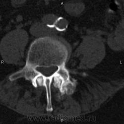 Ct a coloanei vertebrale lombare