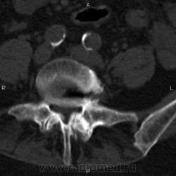 Ct a coloanei vertebrale lombare