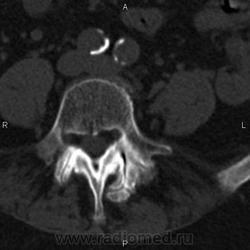 Ct a coloanei vertebrale lombare