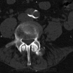 Ct a coloanei vertebrale lombare