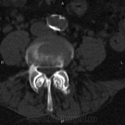 Ct a coloanei vertebrale lombare