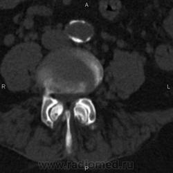 Ct a coloanei vertebrale lombare