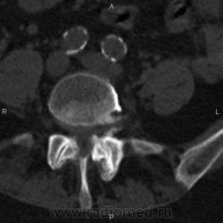 Ct a coloanei vertebrale lombare