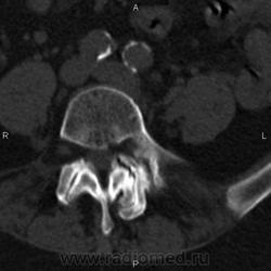 Ct a coloanei vertebrale lombare