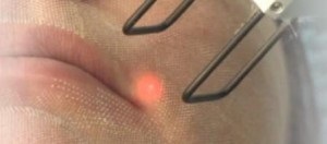 Laser cosmetologie - un personal