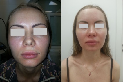 Prețul laser de lustruire a feței, recenzii, foto-cost cu laser de lustruire a feței la Moscova, profund