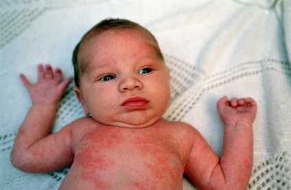 Az allergiás dermatitis kezelése csecsemőknél az orvosi szúnyogoknál