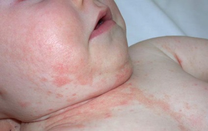 Az allergiás dermatitis kezelése csecsemőknél az orvosi szúnyogoknál
