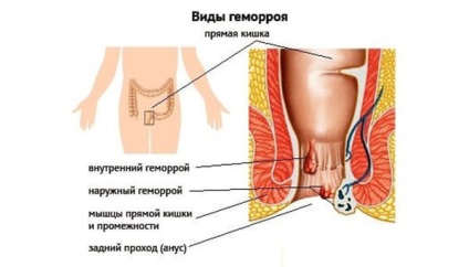 Tratamentul hemoroizilor fără intervenție chirurgicală ca tratament și dacă este posibil să se vindece