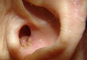 Tratamentul otitei la domiciliu și modul de tratare a inflamației urechilor la adulți și copii