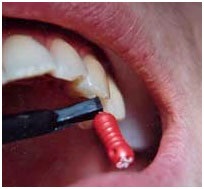 Periodontitis - ooo dentalex kezelése