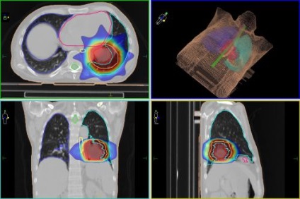 Tratamentul terapiei cu radiații de cancer - clinica cibernetică spizhenko