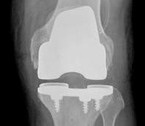Tratamentul bolilor genunchiului cu ajutorul intervențiilor chirurgicale artroscopice