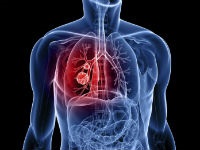 Simptome de sângerare pulmonară, cauze și îngrijire de urgență