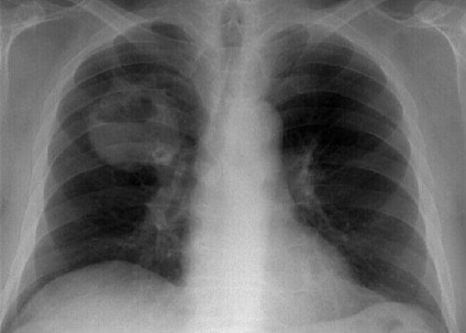 Simptome de sângerare pulmonară, cauze și îngrijire de urgență