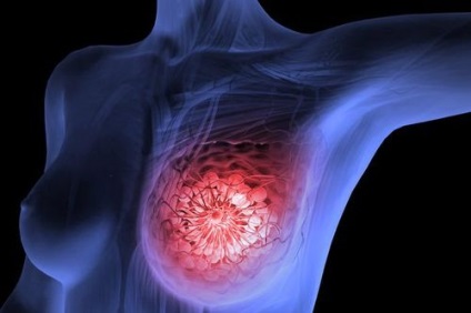 Tipul luminal de cancer mamar
