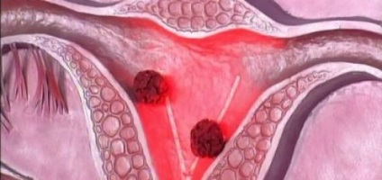 Metastaze pentru cancerul uterin, medicina populară