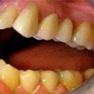 Mituri despre coroane dentare