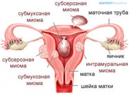 Myoma de dimensiuni uterine mici, la 5, 6, și alte săptămâni și cum să tratăm