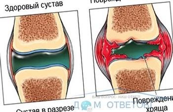 Parapareză inferioară - cauze și tratament - răspunsuri și sfaturi despre dvs.