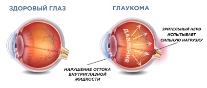 Moszkvában Trubilin professzor szemészeti klinika, Glaukóma kezelés