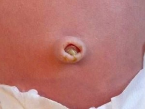 Omfalita la nou-născuți și simptome