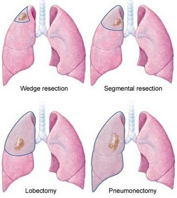 Operație pe plămâni la o tuberculoză - doamnă oraștilă