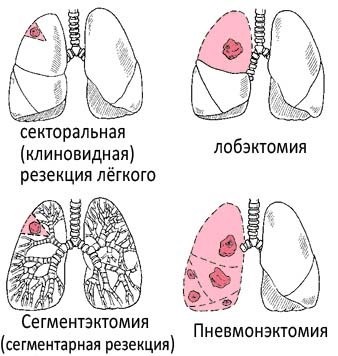 Operație pe plămâni la o tuberculoză - doamnă oraștilă