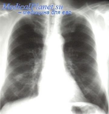 Operație pe plămâni la o tuberculoză - doamnă oraștilă