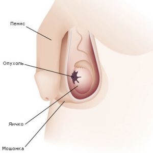 Tumorile cauzate de scrot, simptomele și tratamentul tumorii testiculare la bărbați