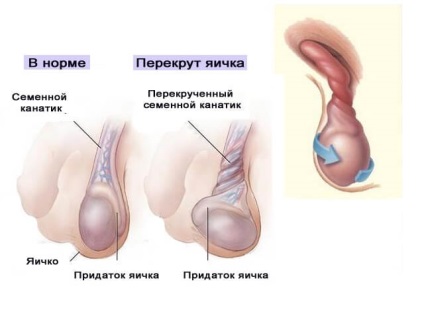 Tumorile cauzate de scrot, simptomele și tratamentul tumorii testiculare la bărbați