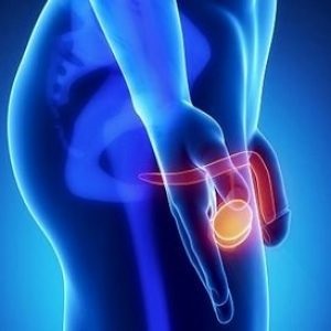 Tumorile cauzate de scrot, simptomele și tratamentul tumorii testiculare la bărbați