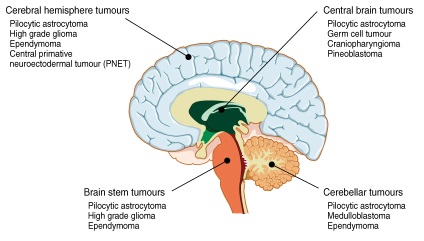 Cerebral tumoral Simptome, diagnostic și tratament