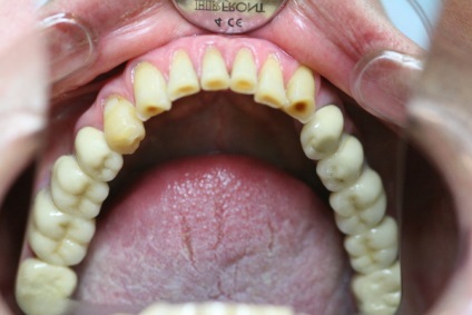 Caracteristicile de finisare a ciucului dintelui - ohi-s
