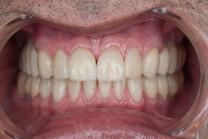 Caracteristicile de finisare a ciucului dintelui - ohi-s