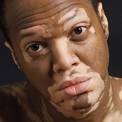 Caracteristicile tratamentului cu vitiligo în China