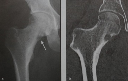 Osteomul osteoid