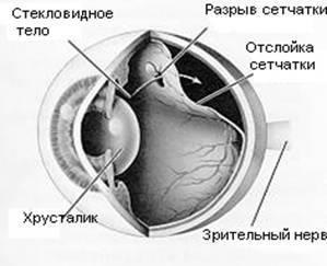 Detașarea retinei - ceea ce a cauzat simptomele detașării retinei