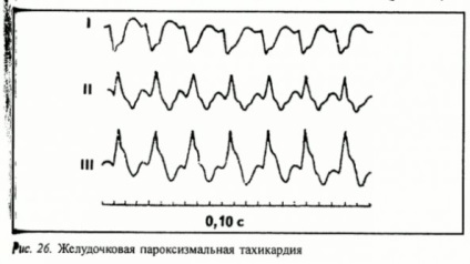 Tahicardia ventriculară paroxistică cauzează, simptome, tratament