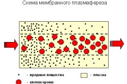 Plasmafereza sângelui (curățarea)