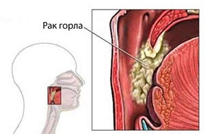 Cauzele și simptomele maladiei cancerului gâtului