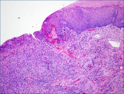 Carcinomul celulelor scuamoase ale primelor simptome ale laringelui, gâtul