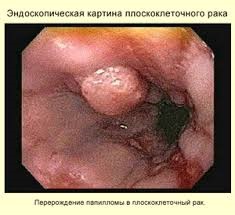 Carcinomul celulelor scuamoase ale laringelui, tratamentul și prevenirea cancerului