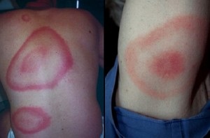 Bőrtünetek reumás reumás csomókkal, erythema