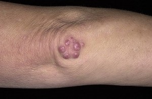 Bőrtünetek reumás reumás csomókkal, erythema