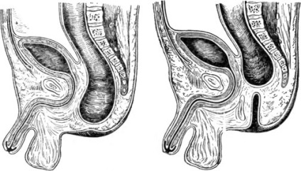 Malformații ale dezvoltării anusului și rectului - chirurgie pediatrică