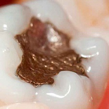Endodontikus kezelés után