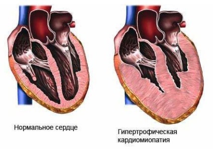 Cauza de deces - cardiomiopatie alcoolică și insuficiență cardiacă - informații despre sănătate