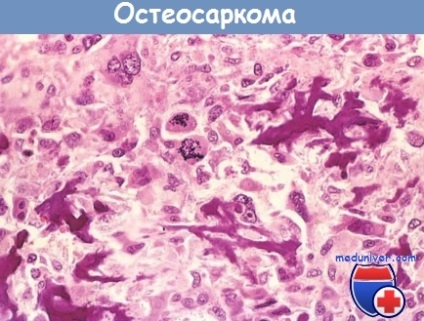 Cauzele și mecanismele dezvoltării tumorilor osoase